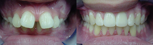 Overbite: Patient A.S. wore a bionator and full braces