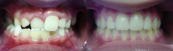 Crossbite: Crossbite of incisor can cause gum problems on lower. Patient M.M. wore an expander and full braces
