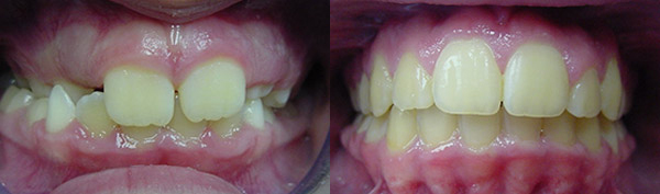 Crossbite: Patient J.B. wore an expander and full braces