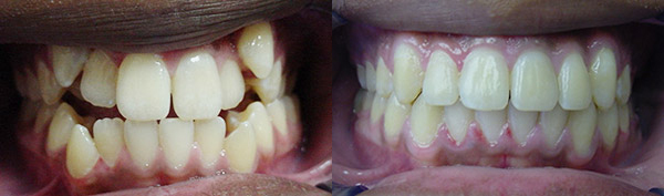 Crowding: Patient A.L. wore an expander, full braces and no permanent teeth were extracted