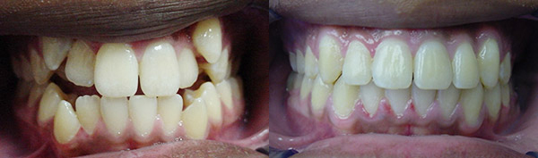 Crowding: Patient A.L. wore an expander, full braces and no permanent teeth were extracted