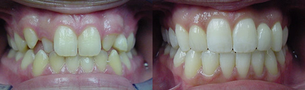 Missing teeth: Patient C.C. wore full braces to prepare for an implant