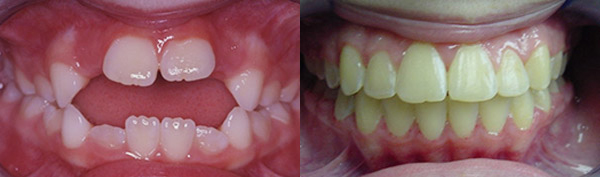 Openbite: Patient K.M. wore an expander and full braces