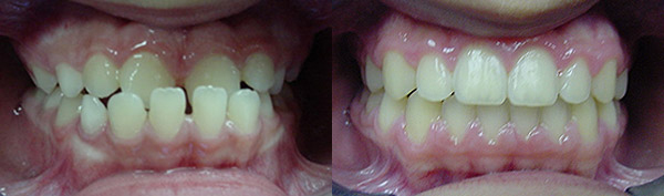 Underbite: Patient J.A. wore an expander, reverse headgear and full braces